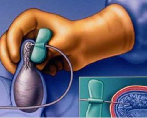 国内供卵试管选男女&能不能人工选择性别,女人染色体异常可以做第三代试管婴